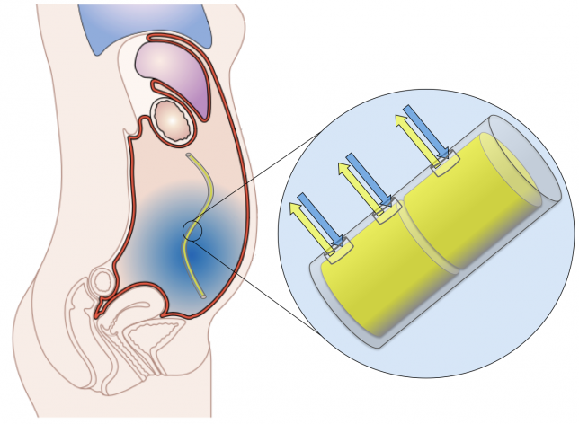 The Ovarian Cancer Project aims to develop implantable chemotherapy devices that improve ovarian cancer care.